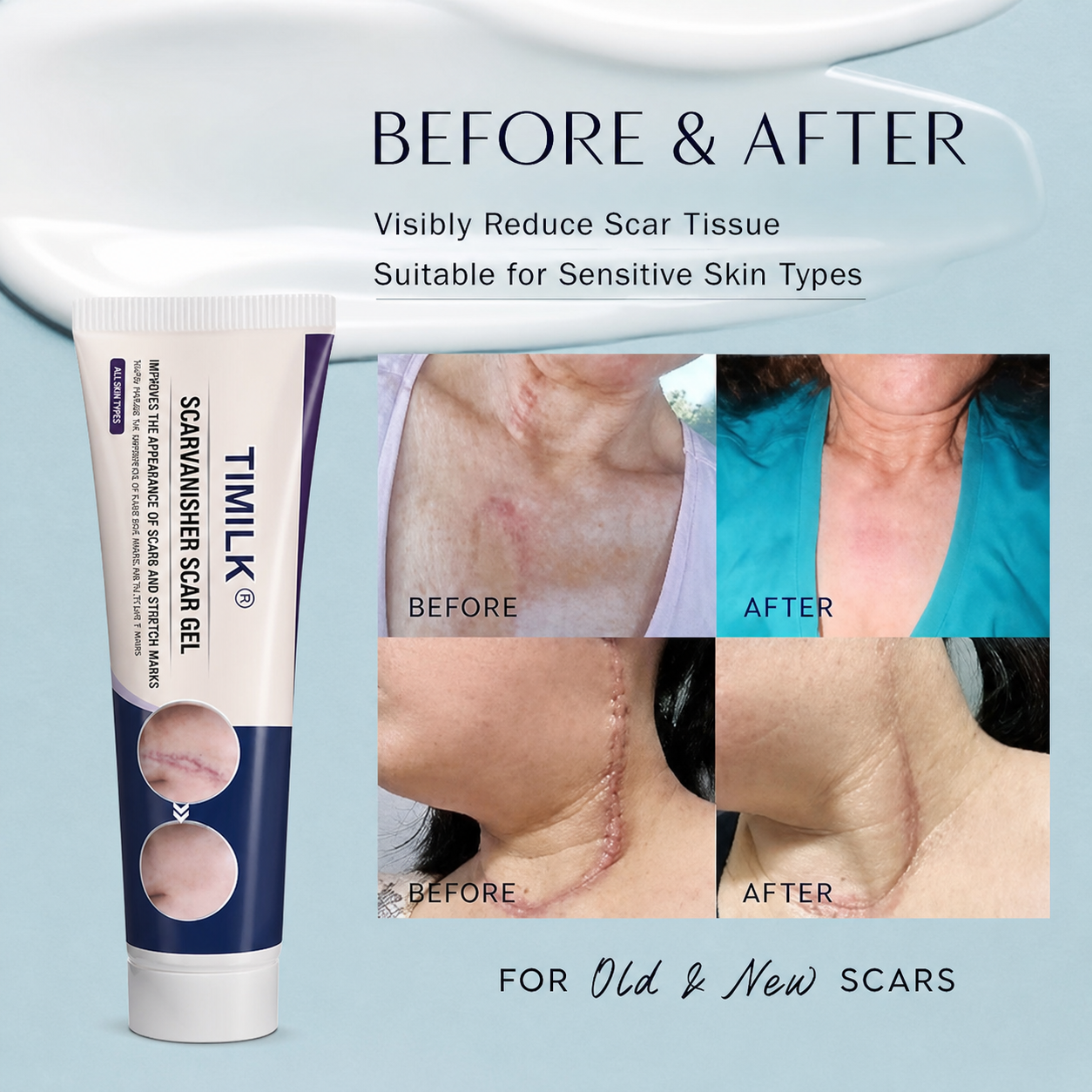 COMBO TIMILK Scar Vanisher Gel – Advanced Silicone Formula for Scars, Stretch Marks & Smooth Skin (Before & After Results)